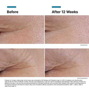Before and after comparison of skin texture improvement over 12 weeks.